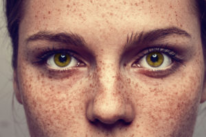 laser-pigmentaire-qswicht-centre-laser-medecine-esthetique-marseille-1